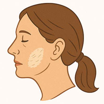 Dry Skin